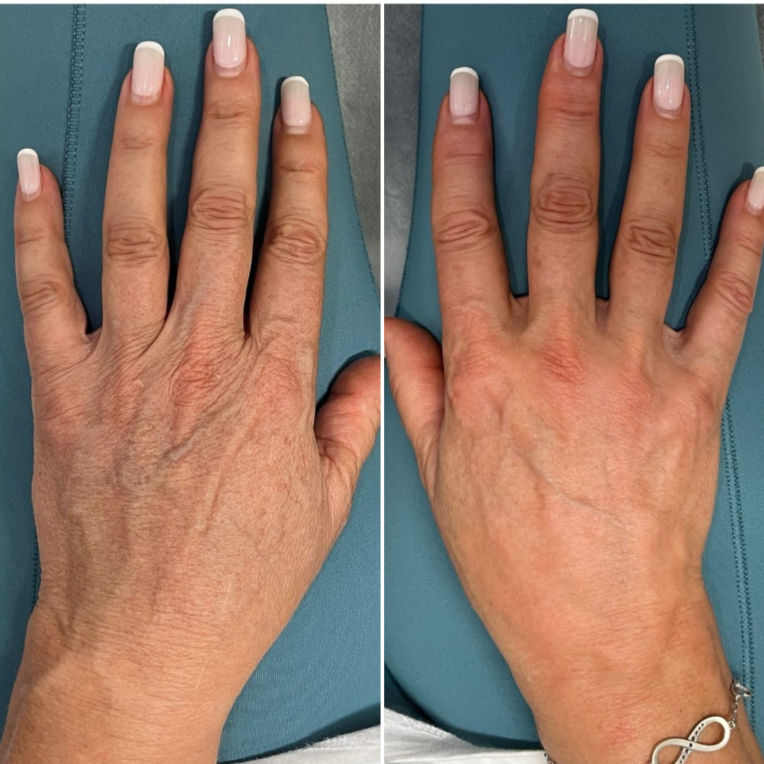 YouthLift Crema Mani al Retinolo